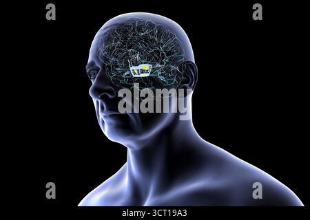 Illustration eines menschlichen Gehirns mit degenerierter Substantia nigra bei Morbus Parkinson, der Verlust pigmentierter Nervenzellen im Mittelhirn im Zusammenhang mit motorischer Dysfunktion zeigt. Stockfoto
