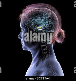 Illustration eines menschlichen Gehirns mit degenerierter Substantia nigra bei Morbus Parkinson, der Verlust pigmentierter Nervenzellen im Mittelhirn im Zusammenhang mit motorischer Dysfunktion zeigt. Stockfoto