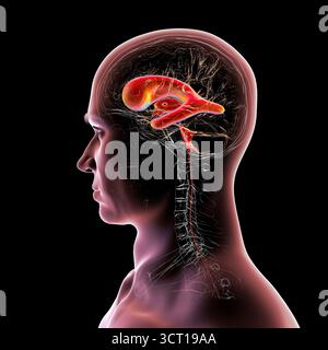 Darstellung eines menschlichen Gehirns mit Normaldruckhydrozephalus. Dies ist eine Erkrankung bei älteren Erwachsenen, bei der sich Zerebrospinalflüssigkeit (CSF) in den Ventrikeln des Gehirns ansammelt, was vergrößerte Ventrikel und eine Kompression des Hirngewebes verursacht. Stockfoto