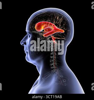 Darstellung eines menschlichen Gehirns mit Normaldruckhydrozephalus. Dies ist eine Erkrankung bei älteren Erwachsenen, bei der sich Zerebrospinalflüssigkeit (CSF) in den Ventrikeln des Gehirns ansammelt, was vergrößerte Ventrikel und eine Kompression des Hirngewebes verursacht. Stockfoto