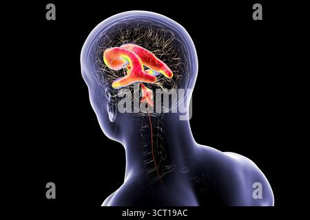 Darstellung eines menschlichen Gehirns mit Normaldruckhydrozephalus. Dies ist eine Erkrankung bei älteren Erwachsenen, bei der sich Zerebrospinalflüssigkeit (CSF) in den Ventrikeln des Gehirns ansammelt, was vergrößerte Ventrikel und eine Kompression des Hirngewebes verursacht. Stockfoto