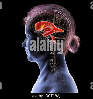 Darstellung eines menschlichen Gehirns mit Normaldruckhydrozephalus. Dies ist eine Erkrankung bei älteren Erwachsenen, bei der sich Zerebrospinalflüssigkeit (CSF) in den Ventrikeln des Gehirns ansammelt, was vergrößerte Ventrikel und eine Kompression des Hirngewebes verursacht. Stockfoto