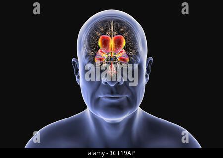 Darstellung eines menschlichen Gehirns mit Normaldruckhydrozephalus. Dies ist eine Erkrankung bei älteren Erwachsenen, bei der sich Zerebrospinalflüssigkeit (CSF) in den Ventrikeln des Gehirns ansammelt, was vergrößerte Ventrikel und eine Kompression des Hirngewebes verursacht. Stockfoto