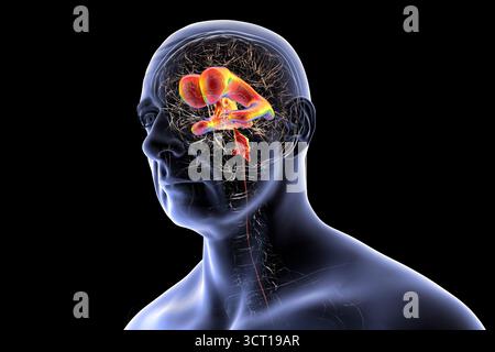 Darstellung eines menschlichen Gehirns mit Normaldruckhydrozephalus. Dies ist eine Erkrankung bei älteren Erwachsenen, bei der sich Zerebrospinalflüssigkeit (CSF) in den Ventrikeln des Gehirns ansammelt, was vergrößerte Ventrikel und eine Kompression des Hirngewebes verursacht. Stockfoto