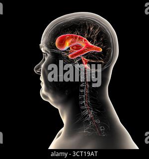 Darstellung eines menschlichen Gehirns mit Normaldruckhydrozephalus. Dies ist eine Erkrankung bei älteren Erwachsenen, bei der sich Zerebrospinalflüssigkeit (CSF) in den Ventrikeln des Gehirns ansammelt, was vergrößerte Ventrikel und eine Kompression des Hirngewebes verursacht. Stockfoto