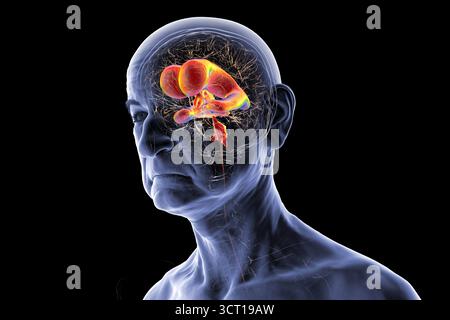 Illustration eines Seniorenhirns mit Normaldruckhydrozephalus. Dies ist eine Erkrankung bei älteren Erwachsenen, bei der sich Zerebrospinalflüssigkeit (CSF) in den Ventrikeln des Gehirns ansammelt, was vergrößerte Ventrikel und eine Kompression des Hirngewebes verursacht. Stockfoto
