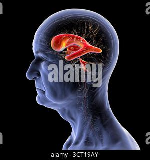 Illustration eines Seniorenhirns mit Normaldruckhydrozephalus. Dies ist eine Erkrankung bei älteren Erwachsenen, bei der sich Zerebrospinalflüssigkeit (CSF) in den Ventrikeln des Gehirns ansammelt, was vergrößerte Ventrikel und eine Kompression des Hirngewebes verursacht. Stockfoto