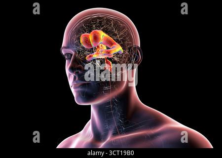 Darstellung eines menschlichen Gehirns mit Normaldruckhydrozephalus. Dies ist eine Erkrankung bei älteren Erwachsenen, bei der sich Zerebrospinalflüssigkeit (CSF) in den Ventrikeln des Gehirns ansammelt, was vergrößerte Ventrikel und eine Kompression des Hirngewebes verursacht. Stockfoto