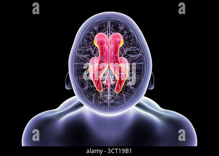 Darstellung eines menschlichen Gehirns mit Normaldruckhydrozephalus. Dies ist eine Erkrankung bei älteren Erwachsenen, bei der sich Zerebrospinalflüssigkeit (CSF) in den Ventrikeln des Gehirns ansammelt, was vergrößerte Ventrikel und eine Kompression des Hirngewebes verursacht. Stockfoto