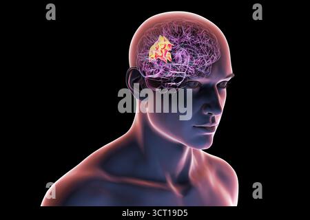 Illustration eines menschlichen Gehirns mit hervorgehobenem Precuneus gyrus. Diese Region war an Gedächtnis, Selbstwahrnehmung und visueller Verarbeitung beteiligt. Stockfoto