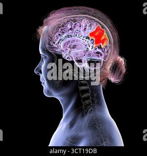 Illustration eines menschlichen Gehirns mit hervorgehobenem Precuneus gyrus. Diese Region war an Gedächtnis, Selbstwahrnehmung und visueller Verarbeitung beteiligt. Stockfoto