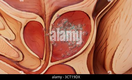 Konzeptuelle Darstellung des männlichen Prostatakarzinoms. Stockfoto