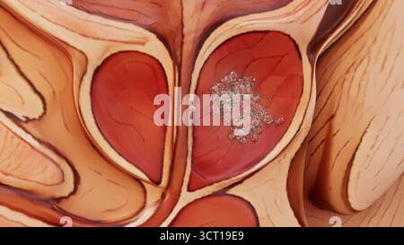 Konzeptuelle Darstellung des männlichen Prostatakarzinoms. Stockfoto