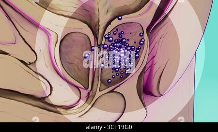 Konzeptuelle Darstellung des männlichen Prostatakarzinoms. Stockfoto