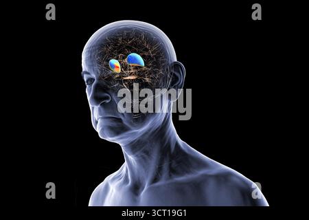 Abbildung eines älteren menschlichen Gehirns mit hervorgehobenem Putamen (blau) und Globus pallidus (gelb), die basale Ganglienstrukturen zeigen, die für die motorische Kontrolle von entscheidender Bedeutung sind und bei Bewegungsstörungen beeinflusst werden. Stockfoto
