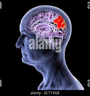 Illustration eines älteren menschlichen Gehirns mit hervorgehobenem Precuneus gyrus. Diese Region ist an Gedächtnis, Selbstwahrnehmung und visuell-räumlicher Verarbeitung beteiligt und wird frühzeitig bei Alzheimer beeinflusst. Stockfoto