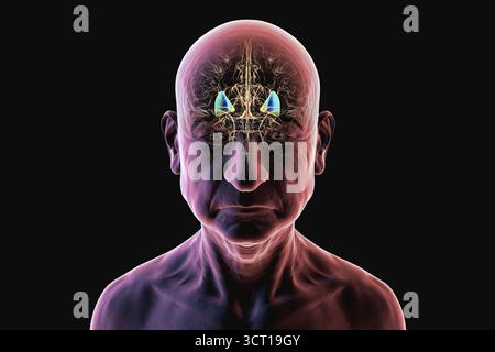 Abbildung eines menschlichen Gehirns mit hervorgehobenem Putamen (blau) und Globus pallidus (gelb), die basale Ganglienstrukturen zeigen, die für die motorische Kontrolle von entscheidender Bedeutung sind und bei Bewegungsstörungen betroffen sind. Stockfoto