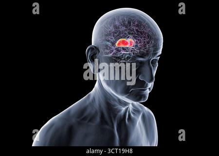Abbildung des menschlichen Gehirns einer älteren Person mit hervorgehobenem Thalamus (rot), zeigt die gepaarten Strukturen der tiefen grauen Substanz, die sensorische und motorische Signale an die Großhirnrinde weiterleiten. Stockfoto