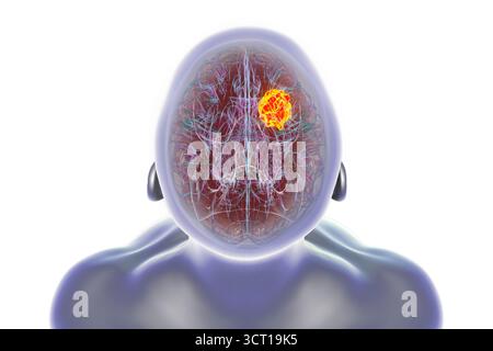 Illustration eines Hirntumors. Ein Hirntumor ist eine Masse abnormer Zellen, die im Gehirn wachsen. Es gibt über 130 Arten von primären Hirntumoren. Sie werden nach der Art der Zellen oder dem Teil des Gehirns benannt, in dem sie beginnen. Stockfoto