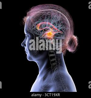 Darstellung der vergrößerten lateralen und dritten Ventrikel des Gehirns (Hydrozephalus), hervorgerufen durch einen Hirntumor, der den Aquädukt des Gehirns komprimiert. Stockfoto