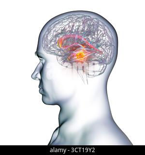Darstellung der vergrößerten lateralen und dritten Ventrikel des Gehirns (Hydrozephalus), hervorgerufen durch einen Hirntumor, der den Aquädukt des Gehirns komprimiert. Stockfoto