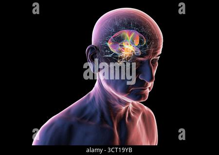 Darstellung der vergrößerten lateralen und dritten Ventrikel des Gehirns (Hydrozephalus) bei einer Seniorin. Dies wird durch einen Hirntumor verursacht, der den Aquädukt des Gehirns komprimiert. Stockfoto