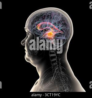 Darstellung der vergrößerten lateralen und dritten Ventrikel des Gehirns (Hydrozephalus), hervorgerufen durch einen Hirntumor, der den Aquädukt des Gehirns komprimiert. Stockfoto