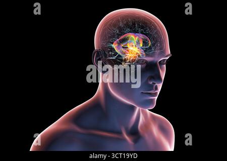 Darstellung der vergrößerten lateralen und dritten Ventrikel des Gehirns (Hydrozephalus), hervorgerufen durch einen Hirntumor, der den Aquädukt des Gehirns komprimiert. Stockfoto