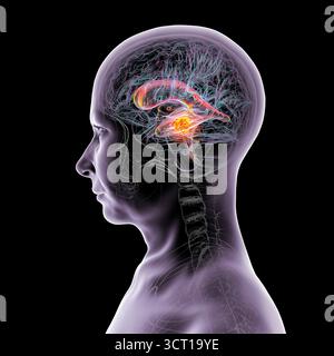Darstellung der vergrößerten lateralen und dritten Ventrikel des Gehirns (Hydrozephalus), hervorgerufen durch einen Hirntumor, der den Aquädukt des Gehirns komprimiert. Stockfoto