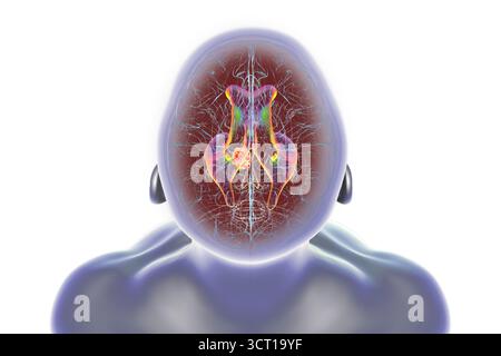 Darstellung der vergrößerten lateralen und dritten Ventrikel des Gehirns (Hydrozephalus), hervorgerufen durch einen Hirntumor, der den Aquädukt des Gehirns komprimiert. Stockfoto