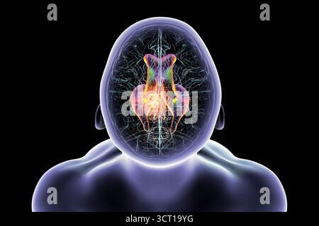 Darstellung der vergrößerten lateralen und dritten Ventrikel des Gehirns (Hydrozephalus), hervorgerufen durch einen Hirntumor, der den Aquädukt des Gehirns komprimiert. Stockfoto