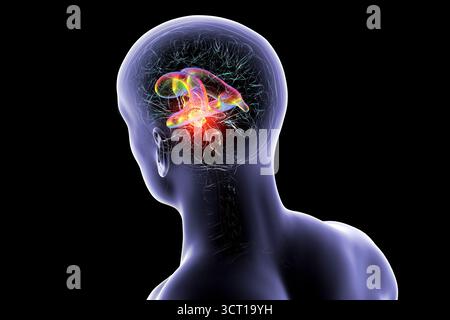 Darstellung der vergrößerten lateralen und dritten Ventrikel des Gehirns (Hydrozephalus), hervorgerufen durch einen Hirntumor, der den Aquädukt des Gehirns komprimiert. Stockfoto
