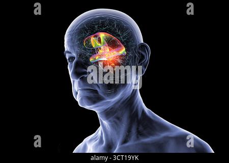 Darstellung der vergrößerten lateralen und dritten Ventrikel des Gehirns (Hydrozephalus) bei einer Seniorin. Dies wird durch einen Hirntumor verursacht, der den Aquädukt des Gehirns komprimiert. Stockfoto