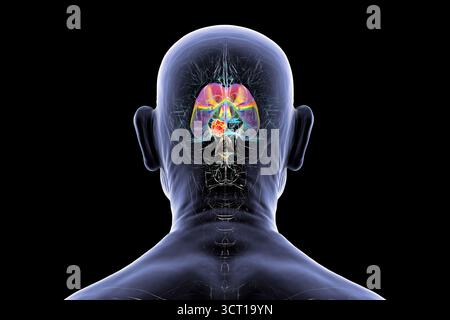 Darstellung der vergrößerten lateralen und dritten Ventrikel des Gehirns (Hydrozephalus) bei einer Seniorin. Dies wird durch einen Hirntumor verursacht, der den Aquädukt des Gehirns komprimiert. Stockfoto