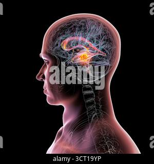 Darstellung der vergrößerten lateralen und dritten Ventrikel des Gehirns (Hydrozephalus), hervorgerufen durch einen Hirntumor, der den Aquädukt des Gehirns komprimiert. Stockfoto