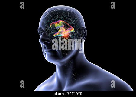 Darstellung der vergrößerten lateralen und dritten Ventrikel des Gehirns (Hydrozephalus), hervorgerufen durch einen Hirntumor, der den Aquädukt des Gehirns komprimiert. Stockfoto
