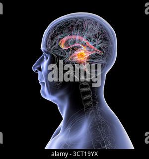 Darstellung der vergrößerten lateralen und dritten Ventrikel des Gehirns (Hydrozephalus), hervorgerufen durch einen Hirntumor, der den Aquädukt des Gehirns komprimiert. Stockfoto