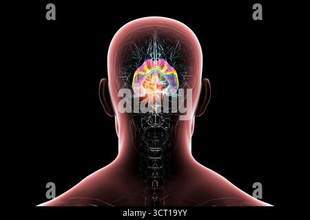 Darstellung der vergrößerten lateralen und dritten Ventrikel des Gehirns (Hydrozephalus), hervorgerufen durch einen Hirntumor, der den Aquädukt des Gehirns komprimiert. Stockfoto