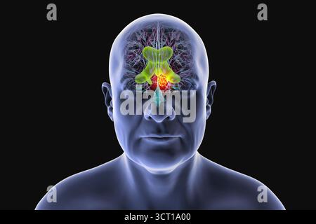 Darstellung der vergrößerten lateralen und dritten Ventrikel des Gehirns (Hydrozephalus), hervorgerufen durch einen Hirntumor, der den Aquädukt des Gehirns komprimiert. Vorderansicht. Stockfoto