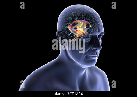Darstellung der vergrößerten lateralen und dritten Ventrikel des Gehirns (Hydrozephalus), hervorgerufen durch einen Hirntumor, der den Aquädukt des Gehirns komprimiert. Stockfoto