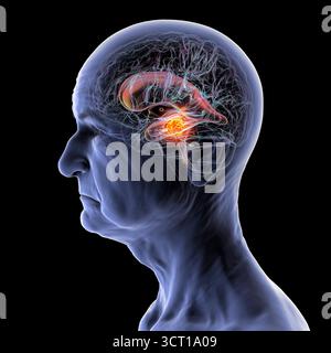 Darstellung der vergrößerten lateralen und dritten Ventrikel des Gehirns (Hydrozephalus) bei einer Seniorin. Dies wird durch einen Hirntumor verursacht, der den Aquädukt des Gehirns komprimiert. Stockfoto