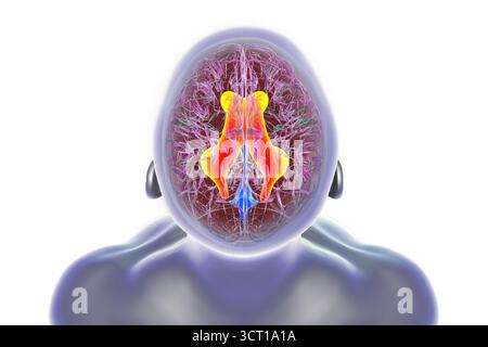 Illustration vergrößerter lateraler Ventrikel des Gehirns (Hydrocephalus). Stockfoto