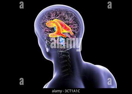 Illustration vergrößerter lateraler Ventrikel des Gehirns (Hydrocephalus). Stockfoto