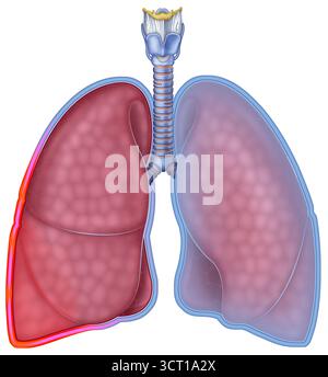 Illustration einer Pleuritis (Pleuraentzündung) betroffenen Lunge. Dies ist gekennzeichnet durch starke Schmerzen, die sich bei tiefem Atmen, Husten oder Niesen verschlimmern. Ursachen sind virale oder bakterielle Infektionen, Brustverletzungen, Pneumothorax, Tumoren oder Krankheiten wie Tuberkulose, Lupus oder Herzinsuffizienz. Stockfoto