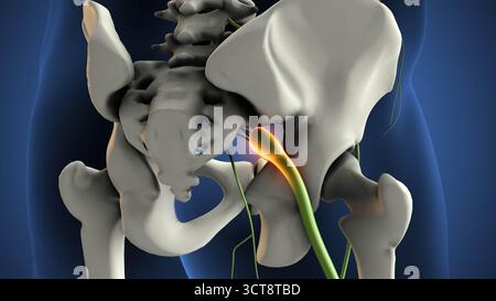 Rechtsseitiges Schwannom des Nervus Ischias Stockfoto