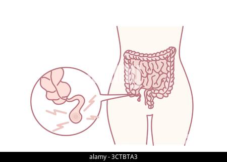 Nahaufnahme des menschlichen Körpers mit entzündetem Blinddarm. Die Person leidet an einer Blinddarmentzündung und muss operiert werden. Vektorgrafik. Stock Vektor