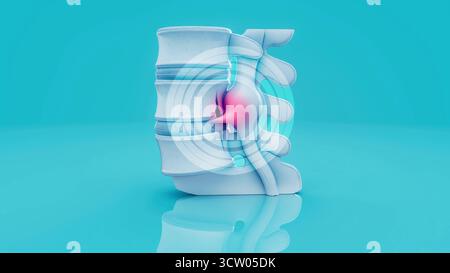 Konzeptionelle 3D-Darstellung eines Bandscheibenvorfalls in der Lendenwirbelsäule Stockfoto