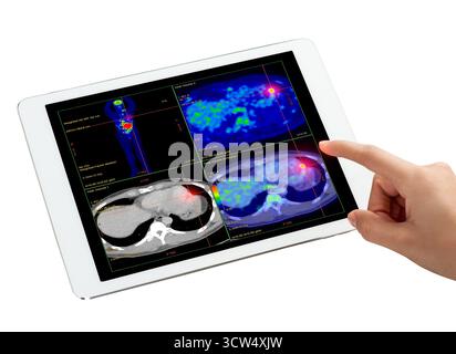 Hand interagiert mit dem Tablet, das PET/CT-Scans anzeigt. Die diagnostische Bildgebung mit Multiview zeigt abnorme Stoffwechselaktivität auf. Ideal für Medizin, Onkologie Stockfoto