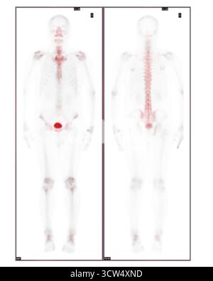 Eine Ganzkörper-Knochenuntersuchung wurde nach intravenöser Injektion von TC-99m MDP durchgeführt. Stockfoto