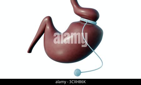 Ein 3D-Bild des Magenbandes ist ein einstellbares, aufblasbares Silikongerät, das in einer Art bariatrischer Chirurgie (Gewichtsverlust-Chirurgie) verwendet wird. Stockfoto